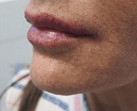 Dermal Fillers