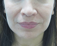 Dermal Fillers