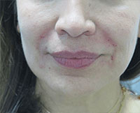 Dermal Fillers