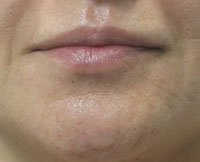 Dermal Fillers