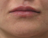 Dermal Fillers