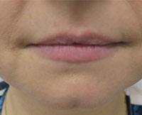 Dermal Fillers