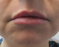 Dermal Fillers