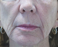 Dermal Fillers