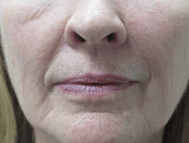 Dermal Fillers