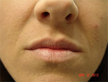 Dermal Fillers