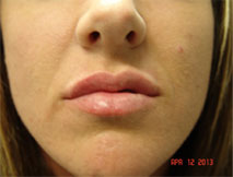 Dermal Fillers