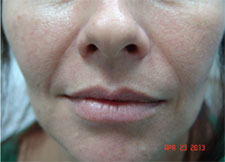 Dermal Fillers