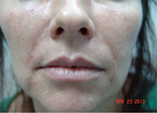 Dermal Fillers