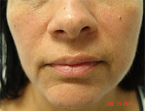 Dermal Fillers