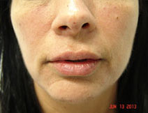 Dermal Fillers