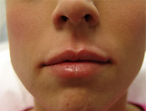 Dermal Fillers