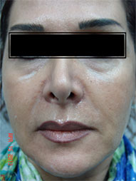 Dermal Fillers