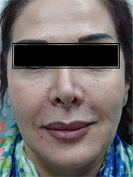 Dermal Fillers