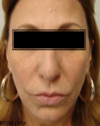 Dermal Fillers