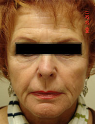 Dermal Fillers