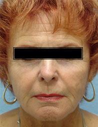 Dermal Fillers