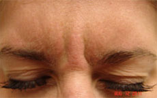 BOTOX® Cosmetic Before & After Photos