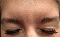 BOTOX® Cosmetic Before & After Photos