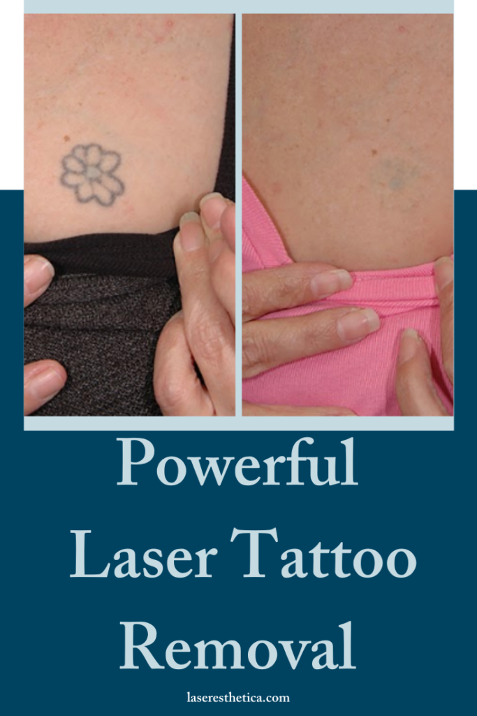 Powerful Tattoo and Pigment Removal - Prasad, Nalini ()