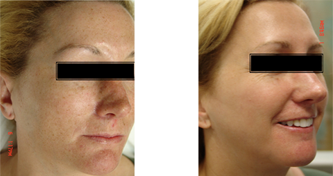 Before and After Skin Tightening