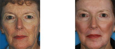 Before and After Fractional Resurfacing