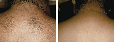 Laser Hair Removal