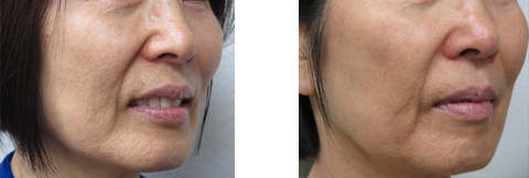 Before and After Fractional Resurfacing