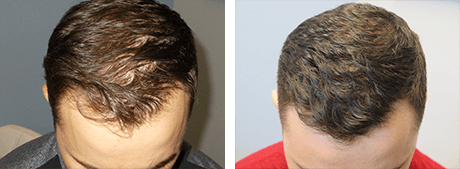 PRP Scalp Roseville | Hair Restoration Sacramento PRP Scalp Roseville | Hair Restoration Sacramento