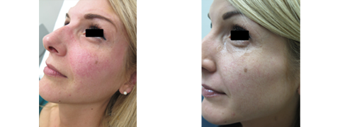 Before and After Facial Capillaries Treatment