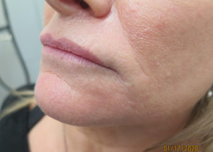 Dermal Fillers