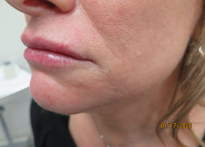 Dermal Fillers