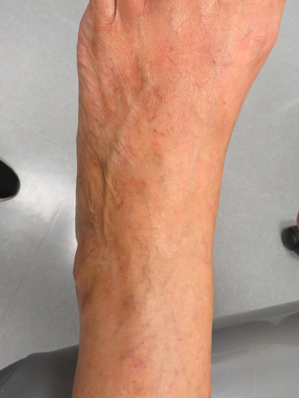 Sclerotherapy