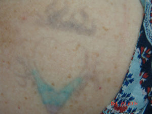 Laser Tattoo Removal