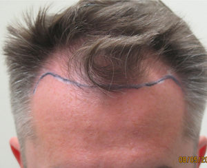 Hair Transplant