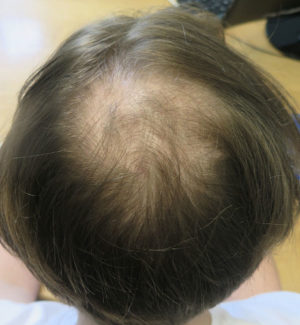 Hair Transplant