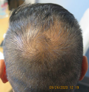 Hair Transplant