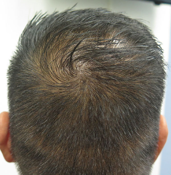 Hair Transplant