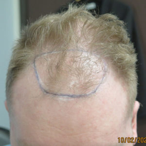 Hair Transplant