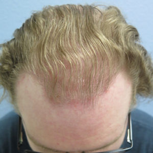 Hair Transplant