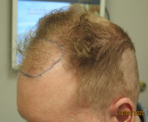 Hair Transplant