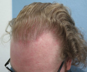 Hair Transplant