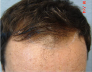 Hair Transplant