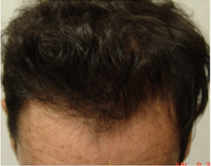 Hair Transplant