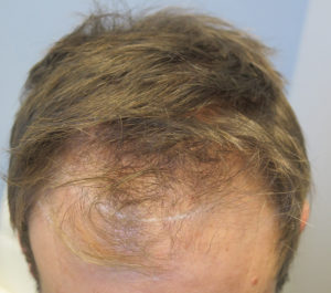 Hair Transplant