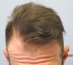 Hair Transplant