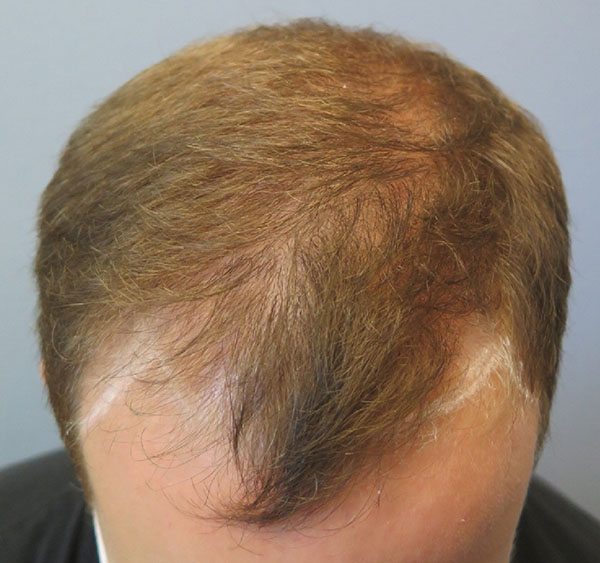 Hair Transplant