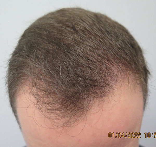 Hair Transplant