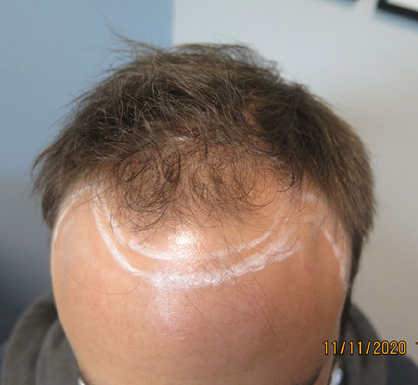 Hair Transplant