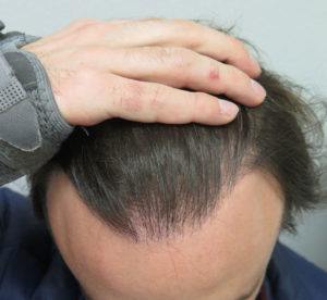 Hair Transplant